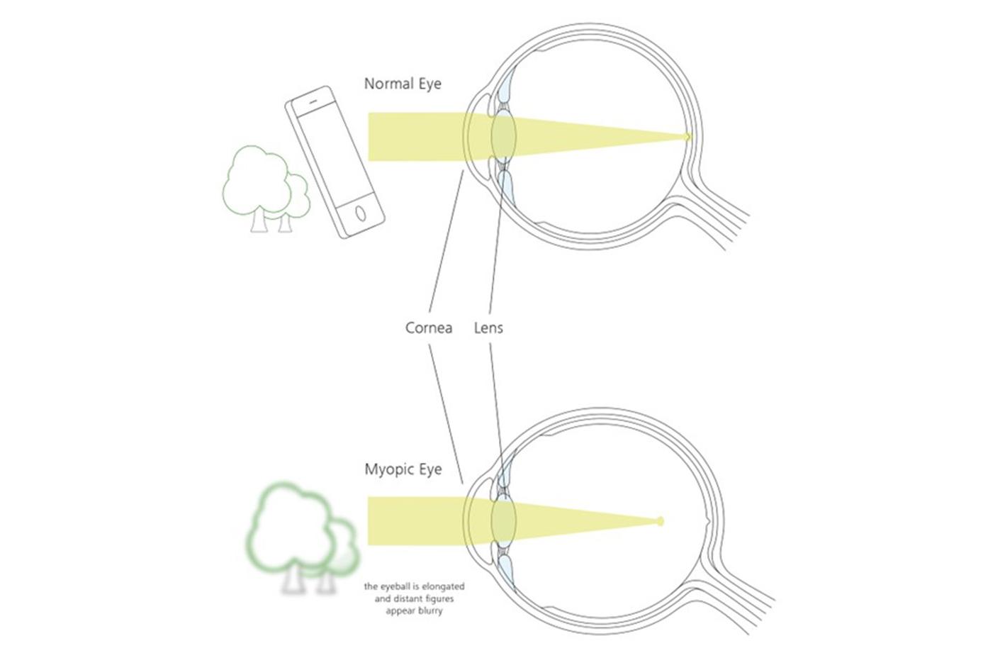 If the eyeball is elongated, light entering the eye reaches its point of focus in front of the retina.