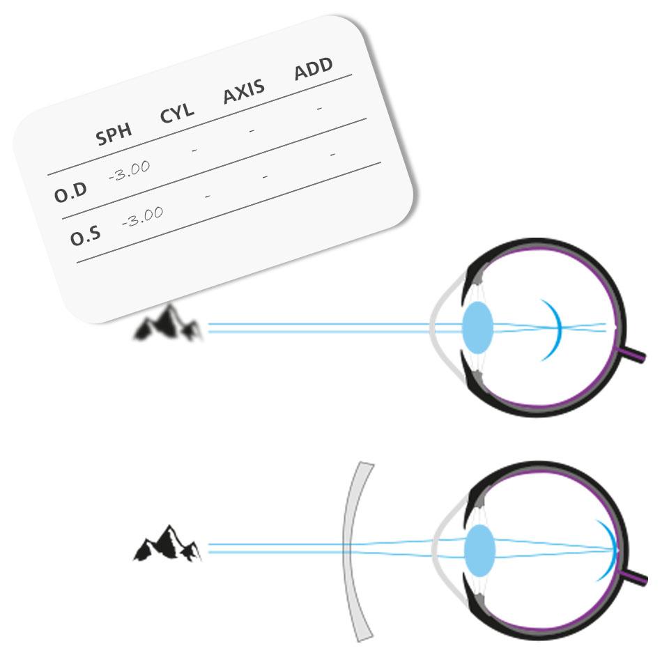 A minus prescription and a concave lens to bend light