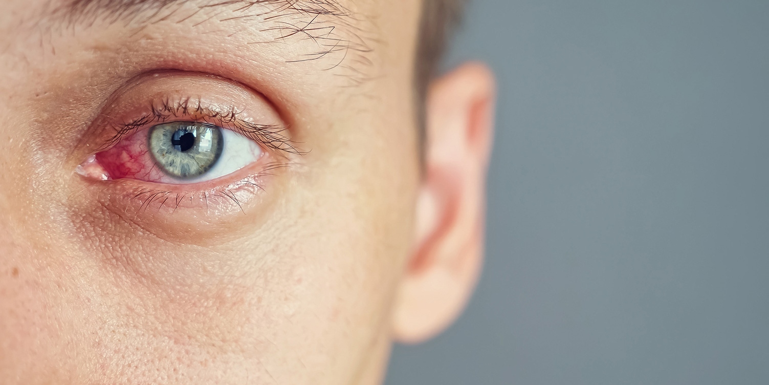 Close up of the red eye of a man affected by an infection, conjunctivitis